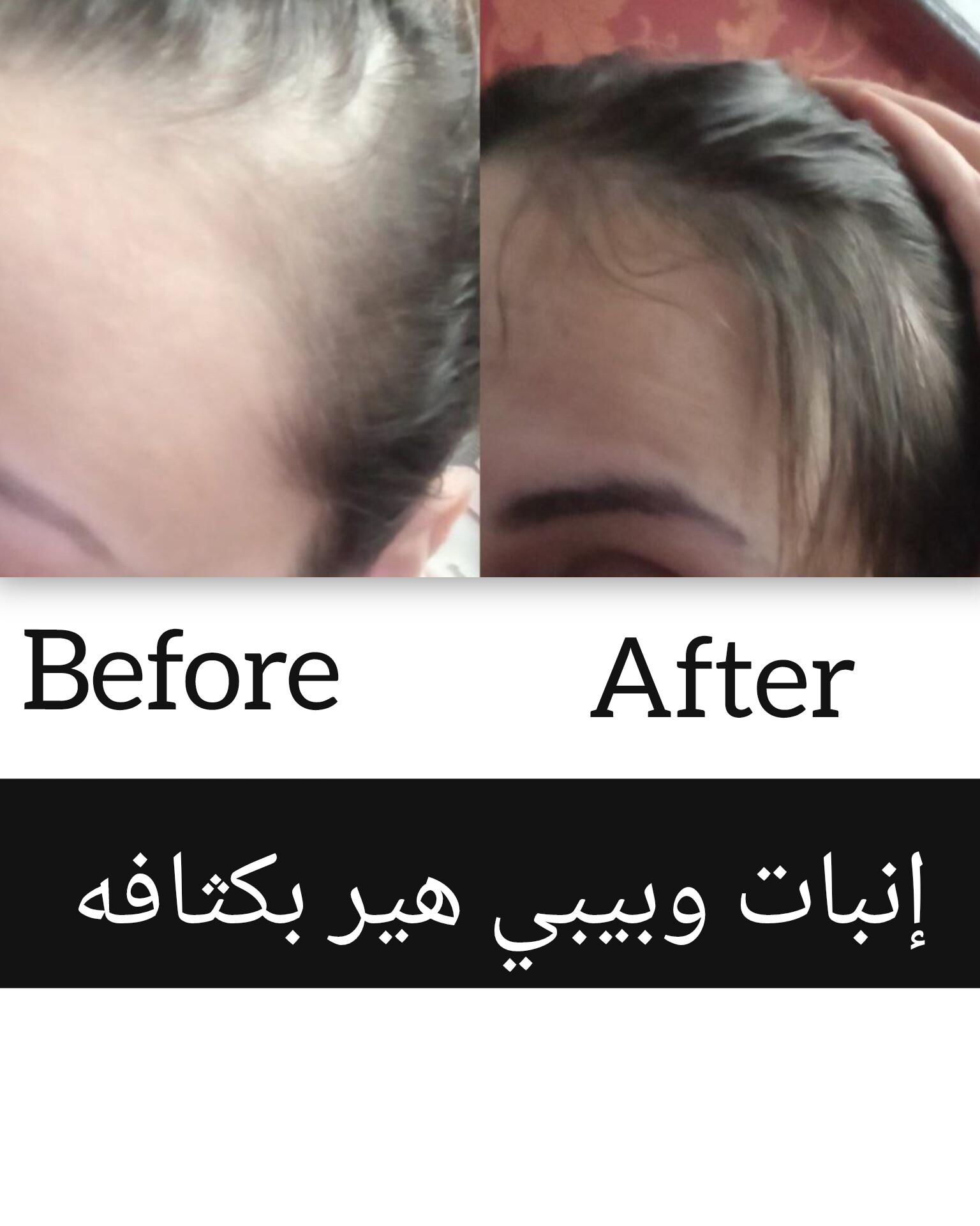 ريفيو انبات الشعر و بيبي هير