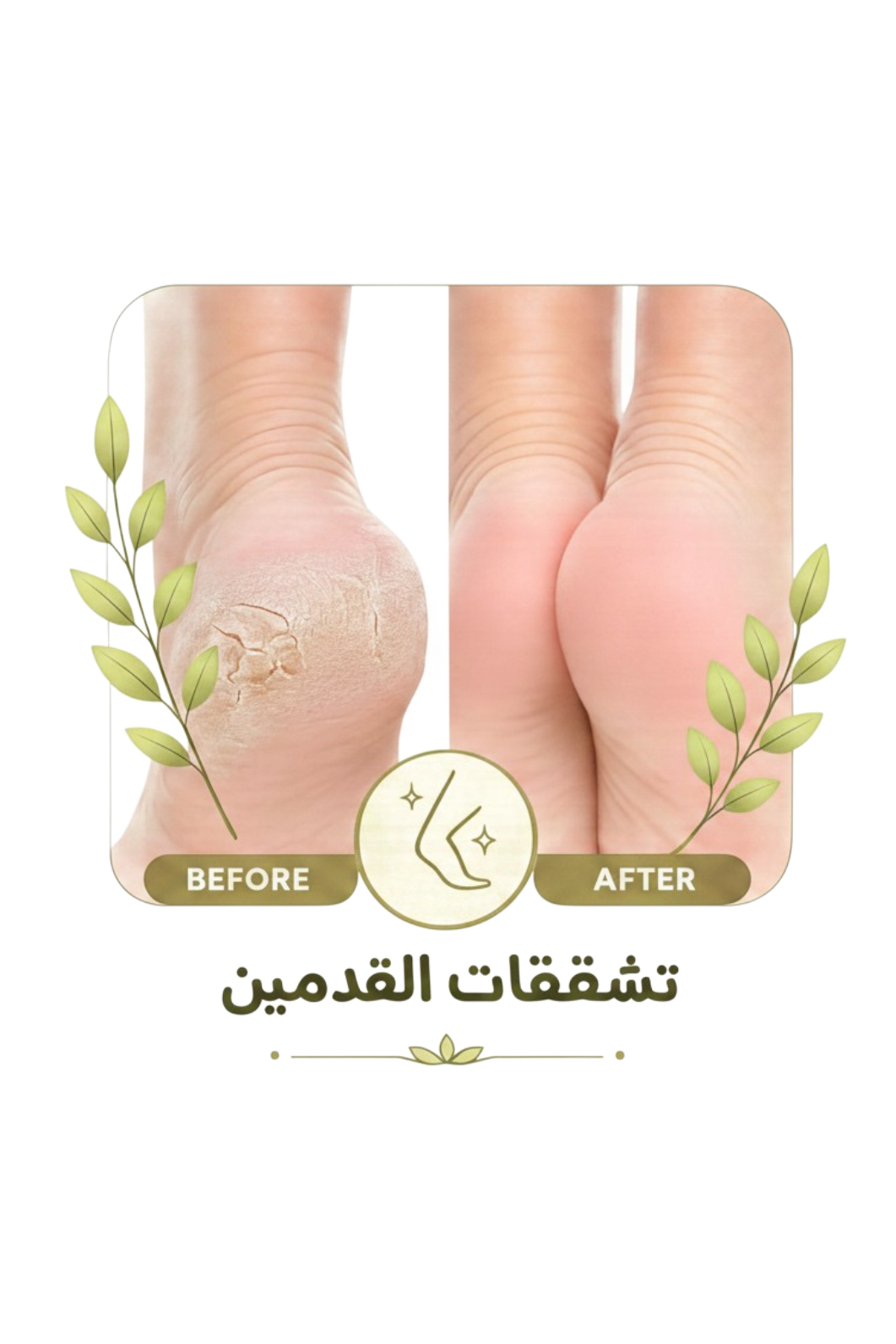 تشققات القدمين